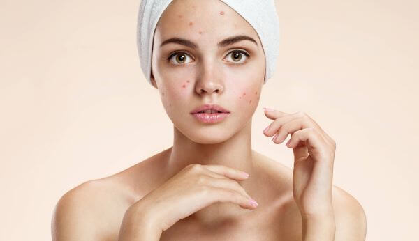 سالیسیلیک اسید برای جوش